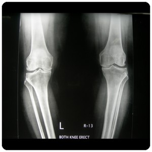 Advance-Surgery-Knee-1