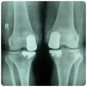 Advance-Surgery-Knee-1A