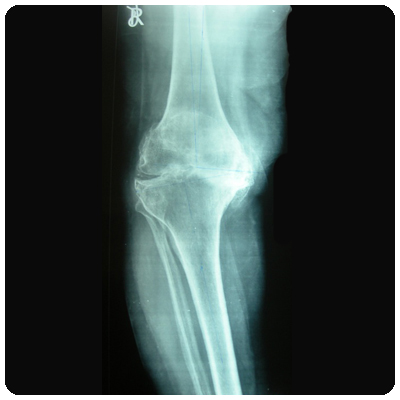 Osteoarthritis with varus deformity showing defect in tibia