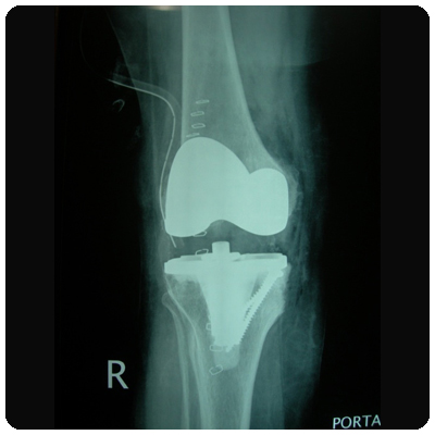 Knee Replacement with screws to fill tibial defect