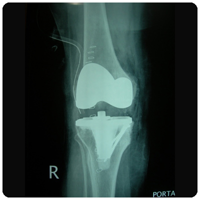 Knee Replacement with screws to fill tibial defect