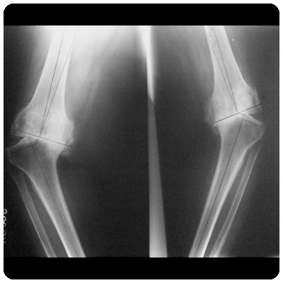 Non aligned knees with severe varus deformity