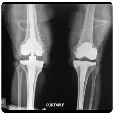 Total knee replacement using tibial wedges to correct deformity