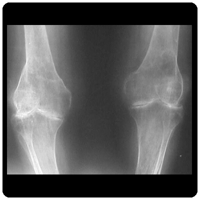 Bilateral rheumatoid arthritis with flexion deformity
