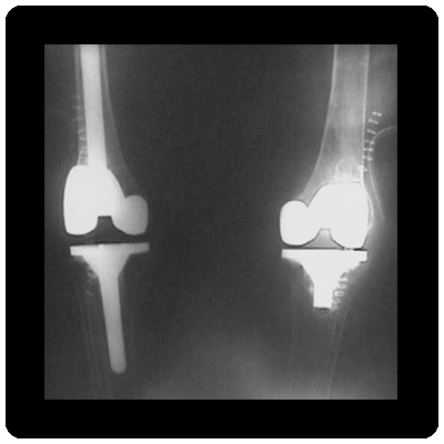 Bilateral total knee replacement after correction of deformity