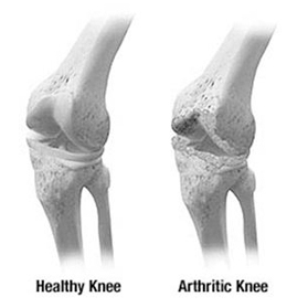 Normal And Deficient Knee