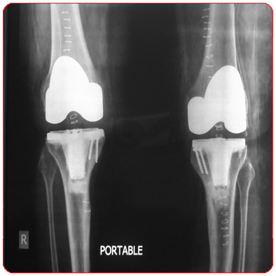 Satisfactory outcome from Biletral Knee Replacement