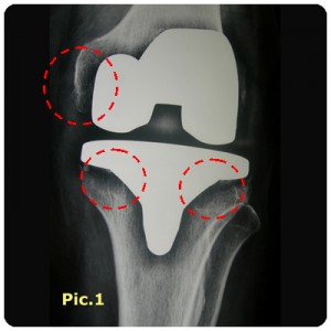 Revision-Knee-1