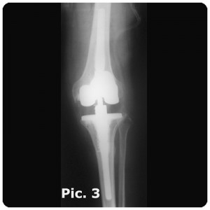 Revision-Knee-1A