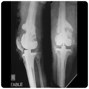 Revision-Knee-3A