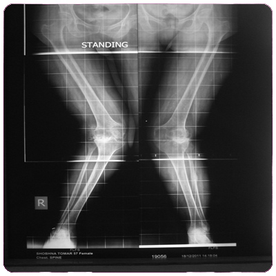 Patients with seviour valgus deformity