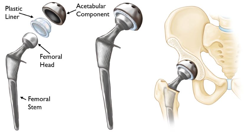 revision hip replacement