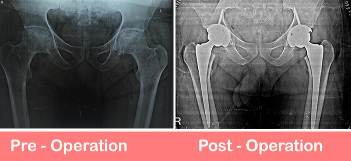 bilateral-total-hip-replacement