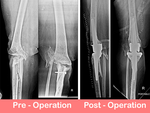 Post traumatic primary complex knee replacement