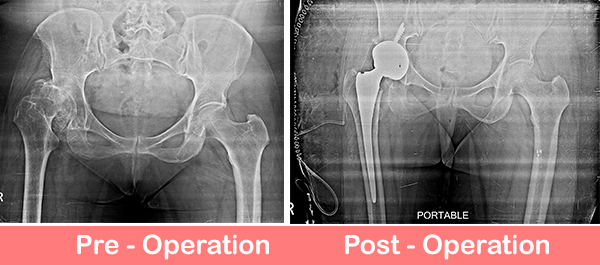 Dysplastic Hip Uncemented-Total-Hip-Replacement