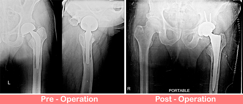 Revision Uncemented Total Hip Replacement