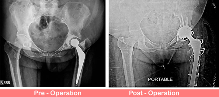 Uncemented THR with constrained liner with the wiring of extended trochanteric osteotomy