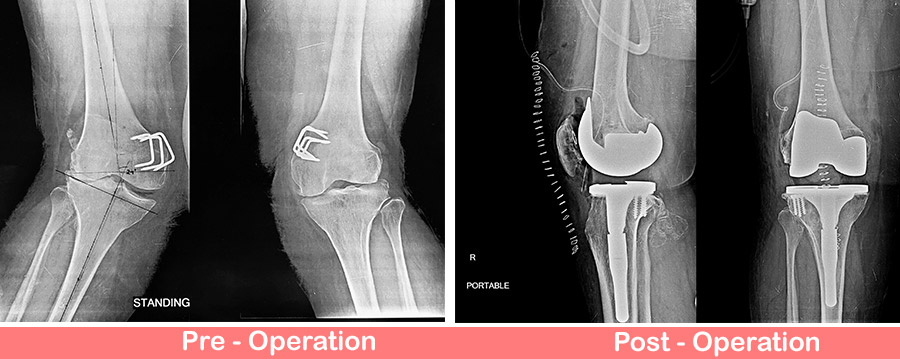 Valgus Knees - Total Knee Replacement