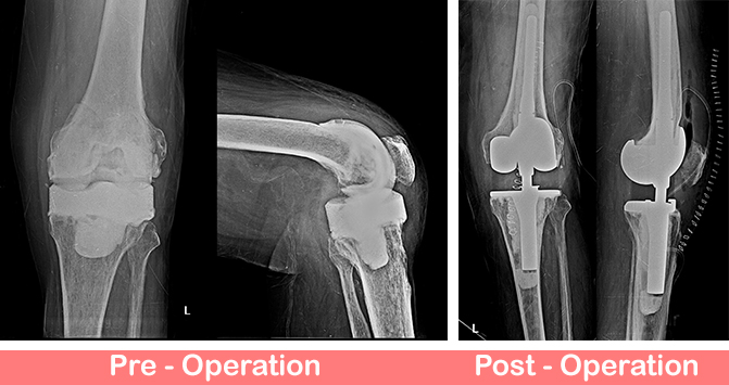 Revision-Total-Knee-Replacement-For-Infection-Rotating-Hinge-Knee