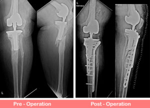 Revision Total Knee Replacement (Rotating Hinge Knee) | Dr. Shekhar Agarwal