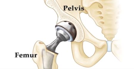 Hip Replacement