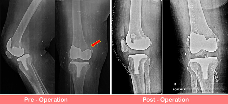 Periprosthetic Fracture right knee 