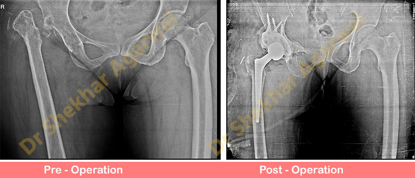 Revision Total Hip Replacement 