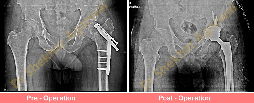 Conversion Total Hip Replacement 