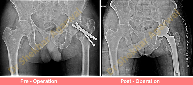 Conversion Total Hip Replacement