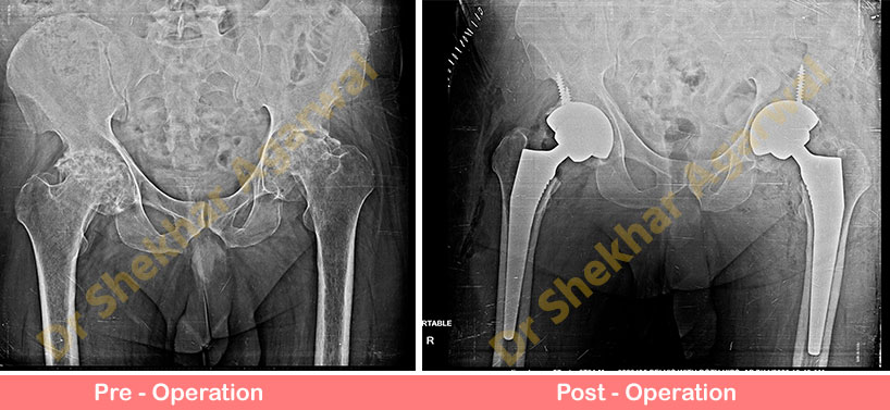 Bilateral Primary Total Hip Replacement