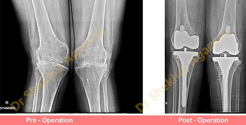 Primary Complex Total Knee Replacement ( Valgus Knee ) 