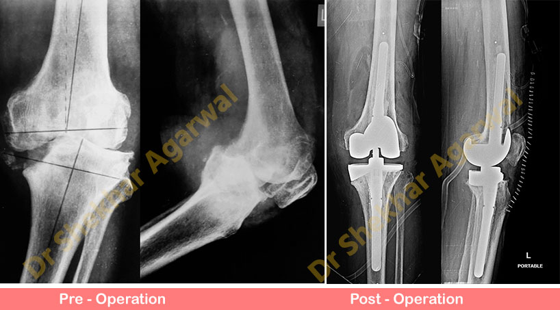 Primary Complex Total Knee Replacement