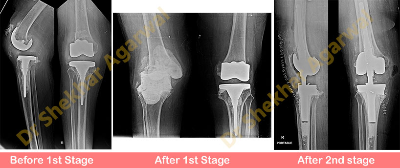 Revision Total Knee Replacement (RHK)