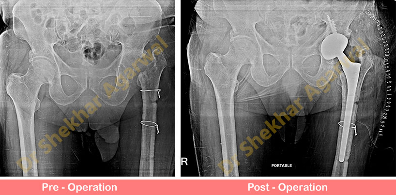 Revision Complex Total Hip Replacement