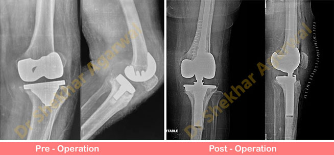 Revision Knee Replacement (RHK)